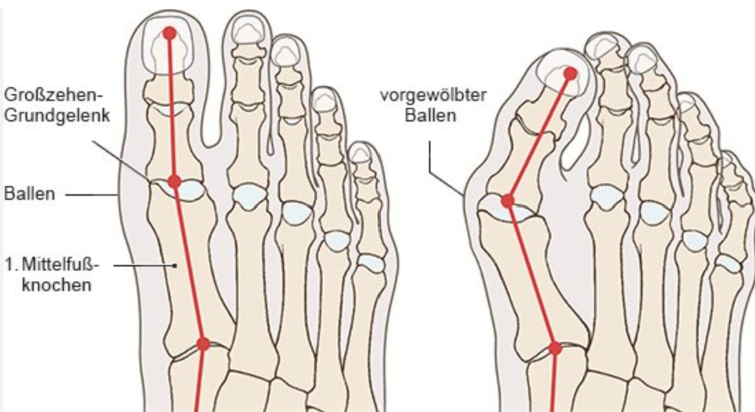 Zehenstütze gegen Ballenzeh (Hallux Valgus)